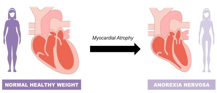 anorexic heart