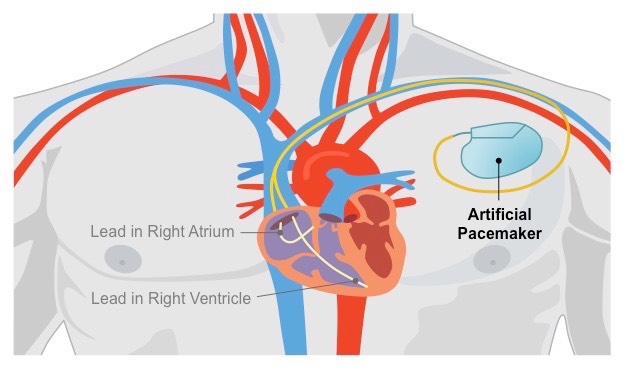 artificial pacemaker