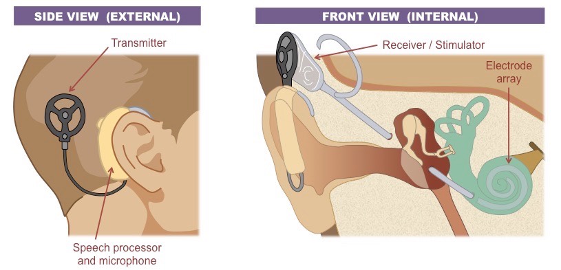 cochlear implant