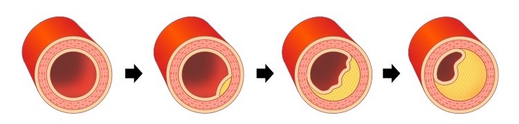 coronary plaque