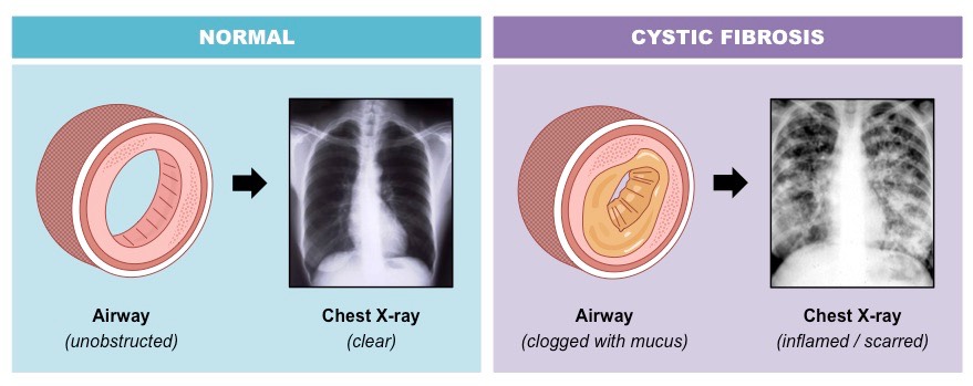 cystic fibrosis