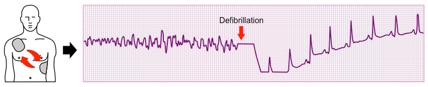 defibrillation