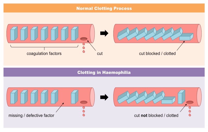 haemophilia