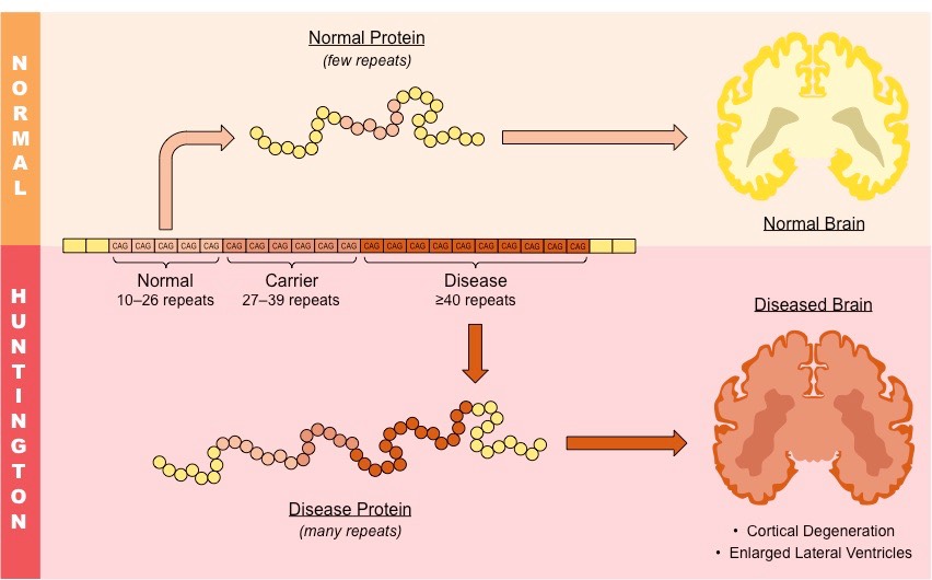 huntingtons disease