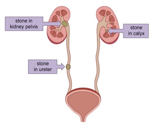 kidney stones