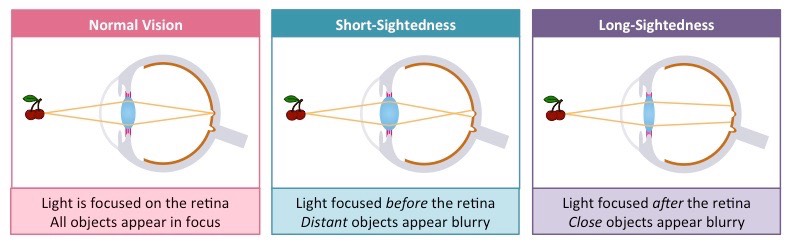 Can You Be Short-sighted in One Eye and Long-sighted in the Other?