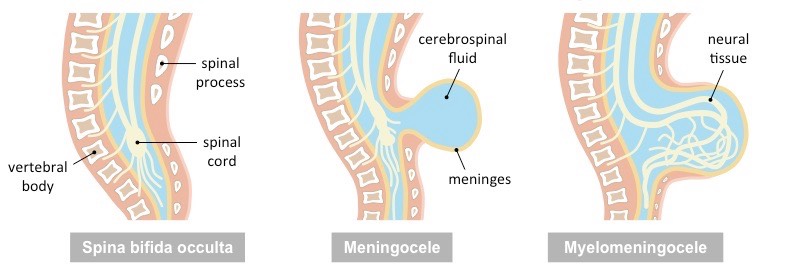 spina bifida